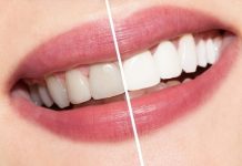 Lo que debes retener sobre el blanqueamiento dental